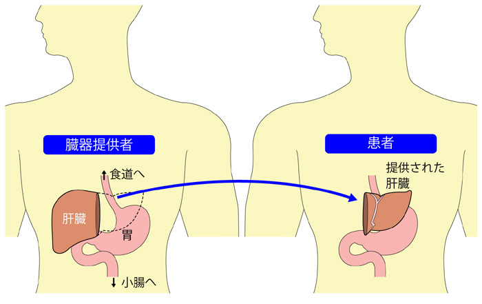 生体肝移植のイメージ