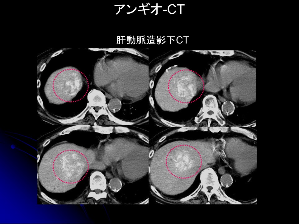 治療前血管造影CT