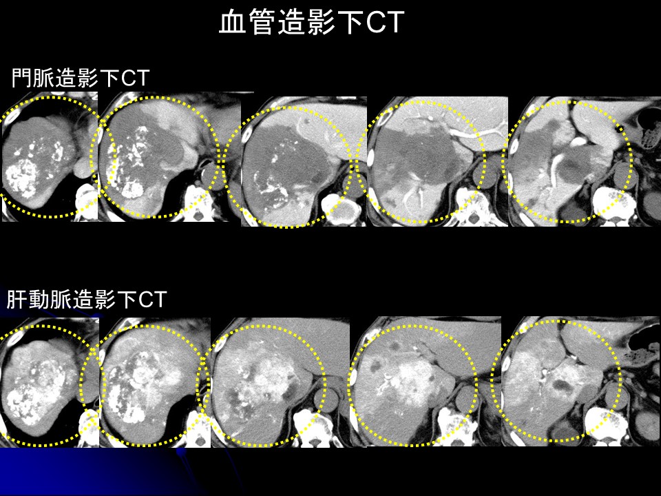 治療前血管造影下CT
